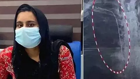 Guide wire entanglement incident; Police to form a special medical board