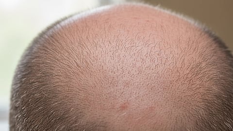 Re grow hair in 20 days, new serum new study