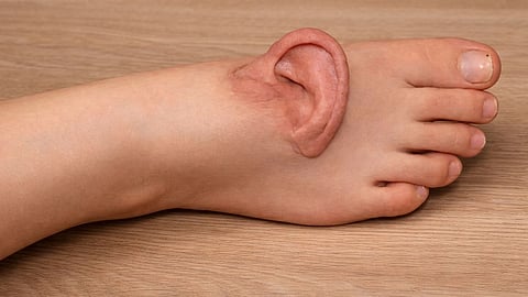 doctors grafted ear on woman leg reattached after months