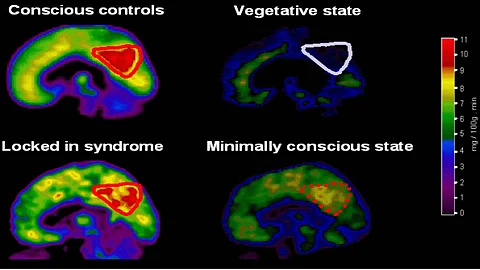 Emerging from a coma: response to language can help assess states of consciousness