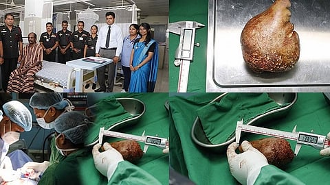 Sri Lankan Army doctors set Guinness World Record by removing world's largest kidney stone