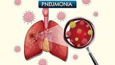 Pneumonia