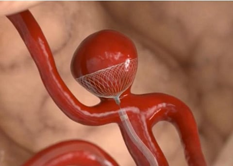 Innovative Trenza device successfully treats brain aneurysm in India