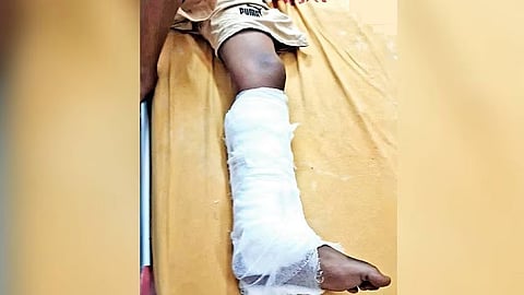 Kerala boy, whose leg was fractured