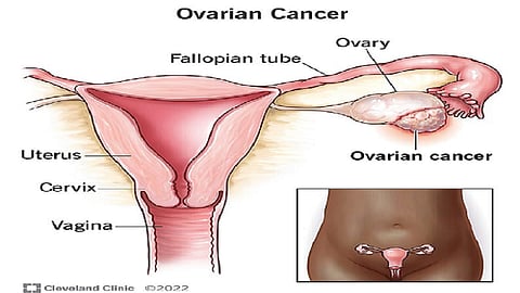 Abdominal symptoms can help detect early-stage ovarian cancer