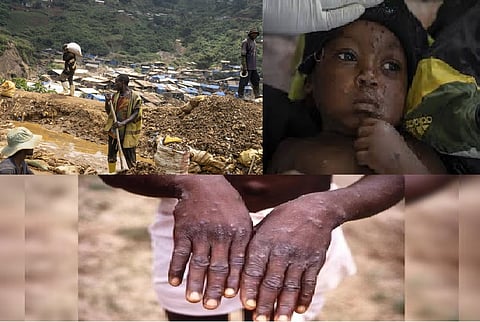 Gold mining town in Congo becomes mpox hot spot as new strain spreads