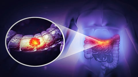 Can vitamin D help prevent colorectal cancer?