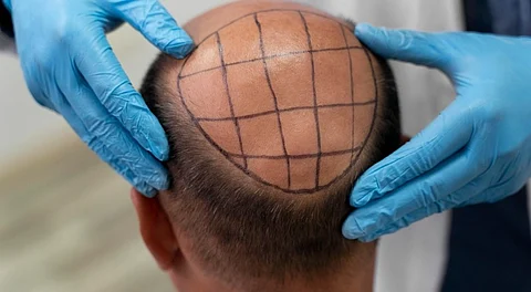 hair transplant