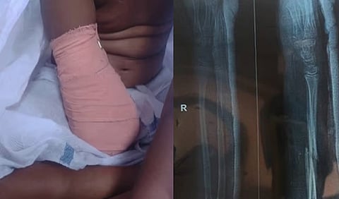 Parents blame district hospital for 'negligence' after girl's arm amputated, govt orders probe