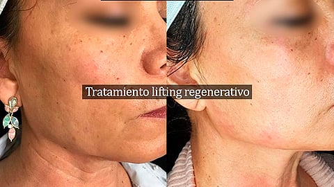 El antes y después de un tratamiento regenerativo sin cirugía