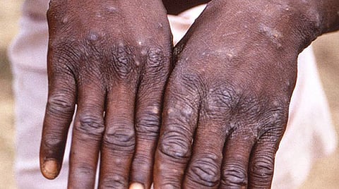 La enfermedad generalmente se presenta con fiebre, sarpullido e inflamación de los ganglios linfáticos