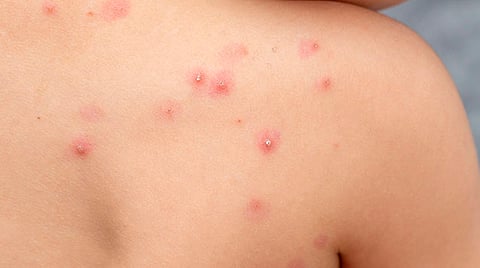 Van 3 mil 455 casos confirmados de viruela del mono y 4 muertes, en México