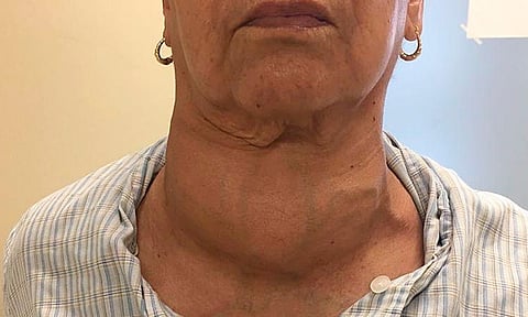 Hiper e hipotiroidismo, principales padecimientos de la glándula tiroides