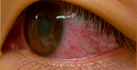 ¿Cuáles son los síntomas del dengue y cuánto tardan en aparecer?