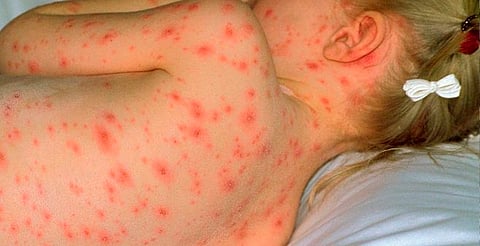 Repuntan casos de varicela en México; aquí te decimos los síntomas y cómo prevenirla