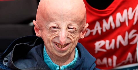 Muere el activista Sammy Basso a los 28 años; visibilizó la progeria