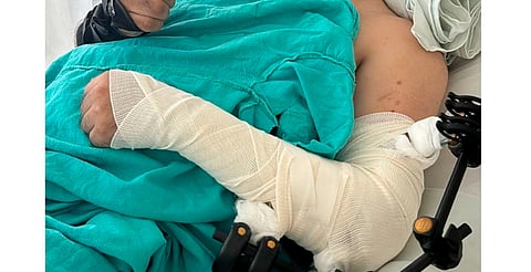 Salvan especialistas del IMSS Michoacán extremidades de paciente con múltiples fracturas