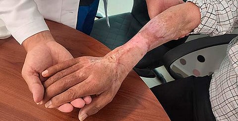 Médicos del IMSS evitan amputación de brazo tras picadura de araña violinista