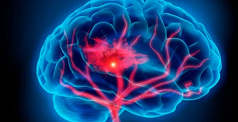 Así puedes identificar signos de alarma de una enfermedad cerebrovascular