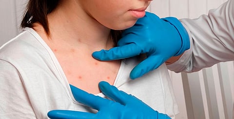 Registra Michoacán 74 casos de sarampión; Yurécuaro bajo vigilancia epidemiológica