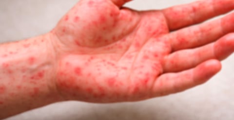 SSa reporta primera muerte por sarampión en Michoacán