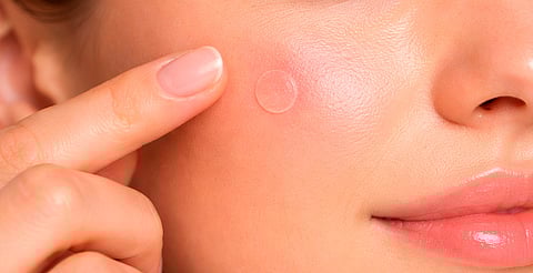 ¡Cuidado! Alertan por venta ilegal de parches para acné en Michoacán