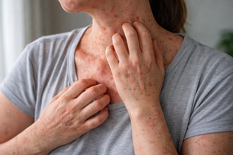 OPS lanza alerta por repunte de sarampión; México, con la mayoría de casos en lo que va del 2026