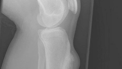 El tumor se ubica en los huesos cerca de la rodilla, el fémur y el húmero (Foto: Archivo)