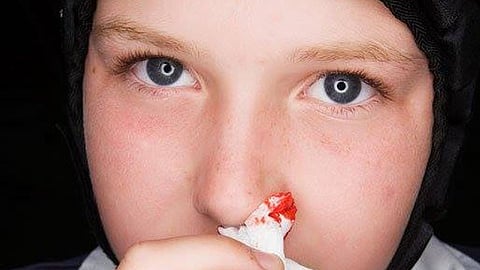 La hemofilia es una enfermedad genética que desarrollan, en la gran mayoría de los casos, sólo los varones