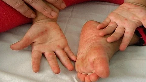 Los pequeños menores a los 5 años son los más propensos a contagiarse (Foto: suckhoebeyeu.info)