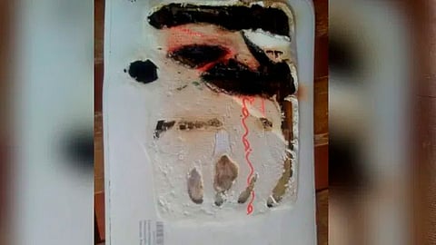 El menor llegó con quemaduras en el 100 % de su cuerpo (Foto: @YanaraVivas)