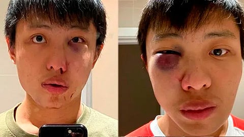 Los golpes en el rostro le provocaron abundante sangrado en la nariz (Foto: Facebook/Jonathan Mok)