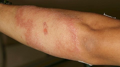 Los síntomas aparecen después de seis meses en forma de bolitas en la piel y además provoca deformidades (Foto: www.sciencedirect.com)