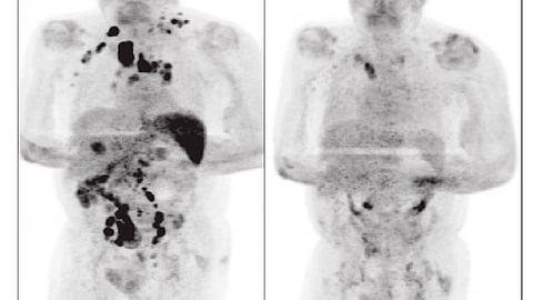 El hombre de 61 años fue diagnosticado con cáncer por linfoma de Hodgkin en etapa 3 (Foto: onlinelibrary.wiley.com)