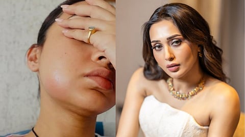 Mimi Chakraborty Injury