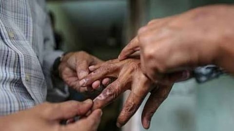 Yavatmal Leprosy Eradication Health Department