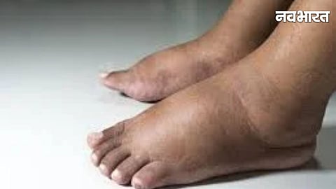 Elephant Foot Disease Maharashtra
