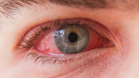 Eye Flu
