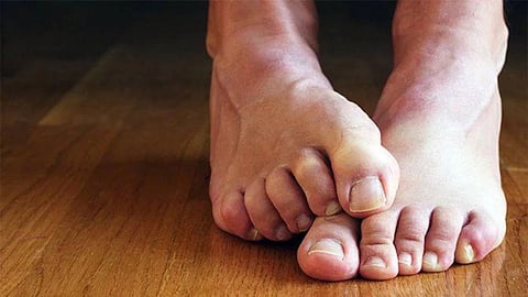 Fungal Infection,Home Remedies