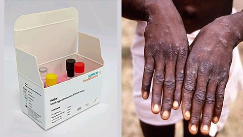 Monkeypox