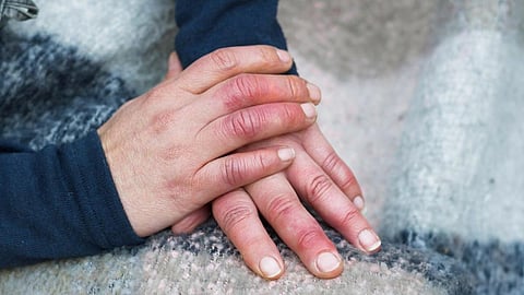 हाथ-पैरों की उंगलियों में सूजन, सर्दी का मौसम