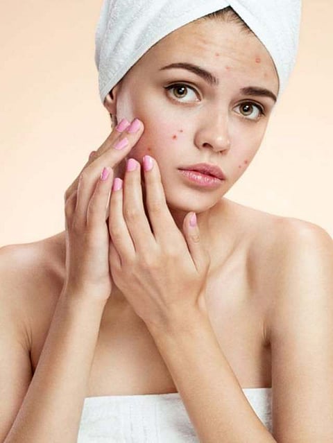 Pimple