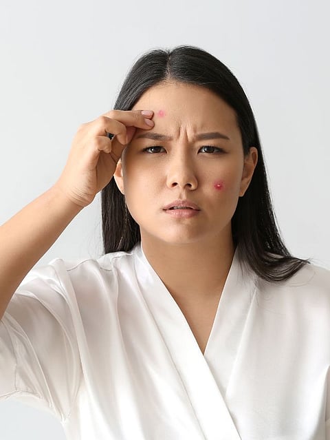 which vitamin deficiency causes pimples