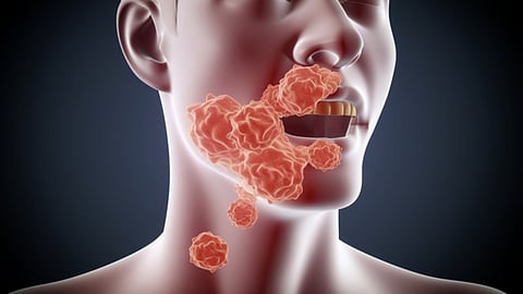 nagpur-cancer-cases-davakhana-apyari-dari-campaign-2023-2025
