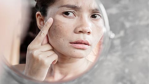चेहरे पर बने काले धब्बे हो सकती है कोई बीमारी