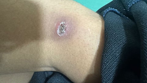 wardha-scrub-typhus-cases-symptoms-alert