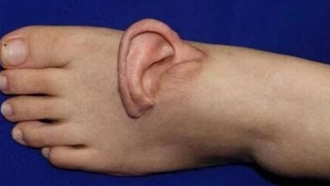 china-surgeon-successfully-performs-woman-ear-foot-transplant-surgery