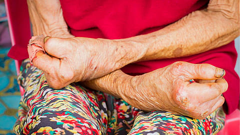 Leprosy, world Leprosy Day 2026