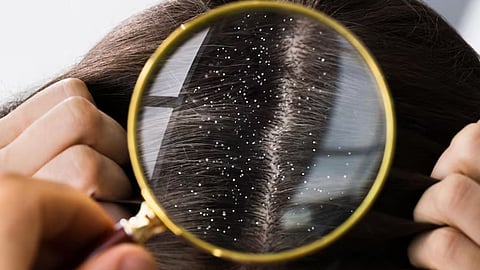 Dandruff Home Remedies