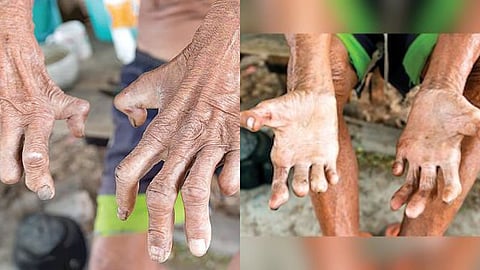 Leprosy-free target by 2027: 'Kusum' leprosy detection campaign to begin in Yavatmal from January 30.